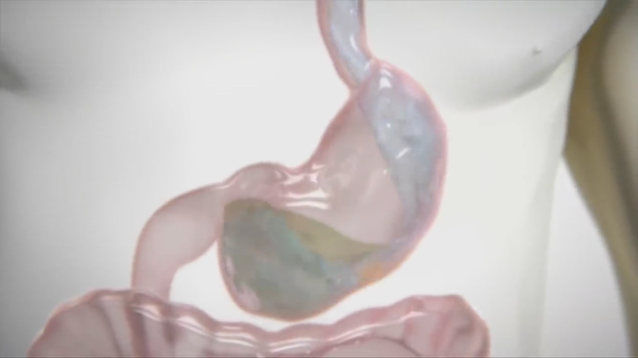 Introducing Plenity, the medication that could make you lose weight