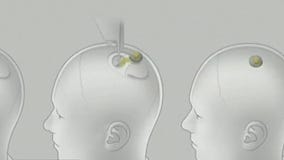 Neuralink: Elon Musk's brain-computer chip