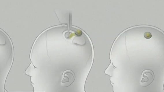 Neuralink: Elon Musk's brain-computer chip