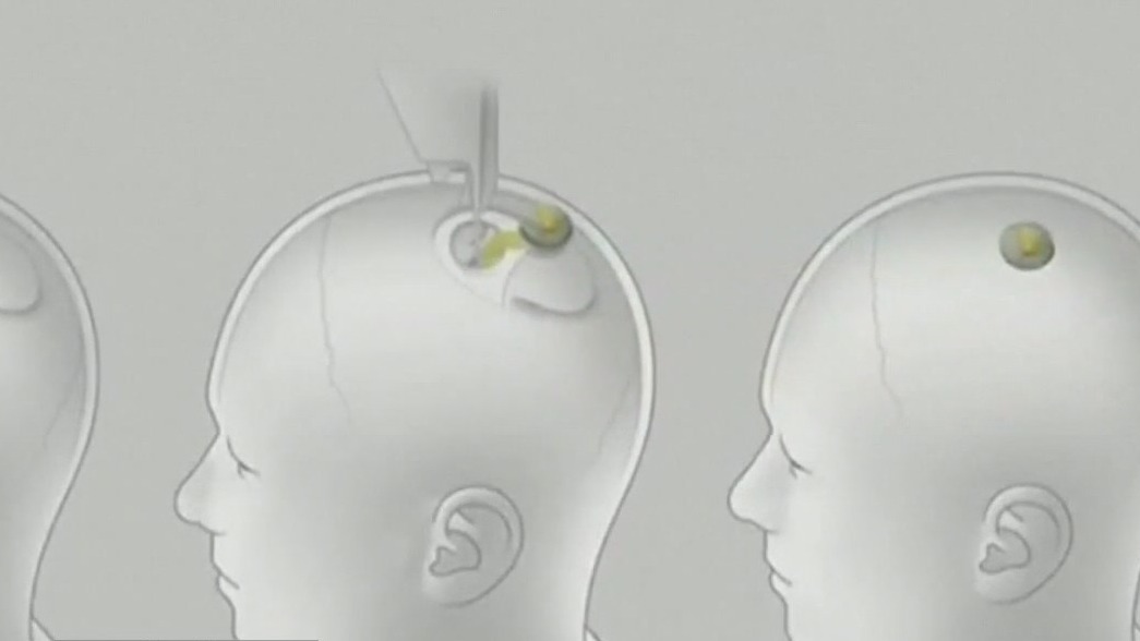 Neuralink: Elon Musk's brain-computer chip