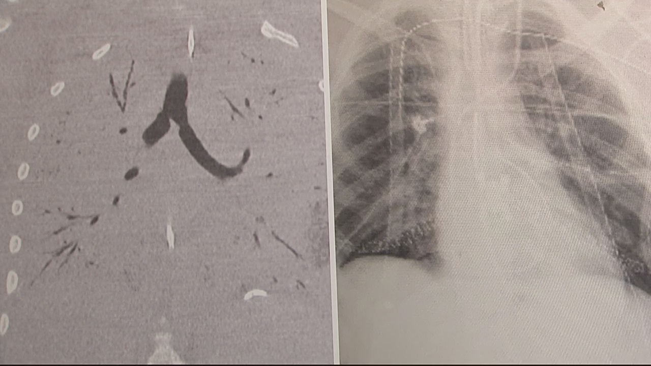 Henry Ford Doctor talks about the first double lung transplant realted to vaping