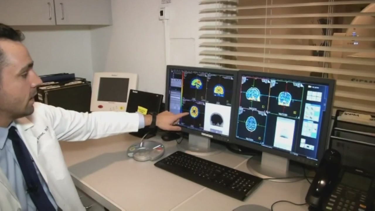 Predicting when someone with epilepsy will have a seizure is almost impossible - but that may be changing