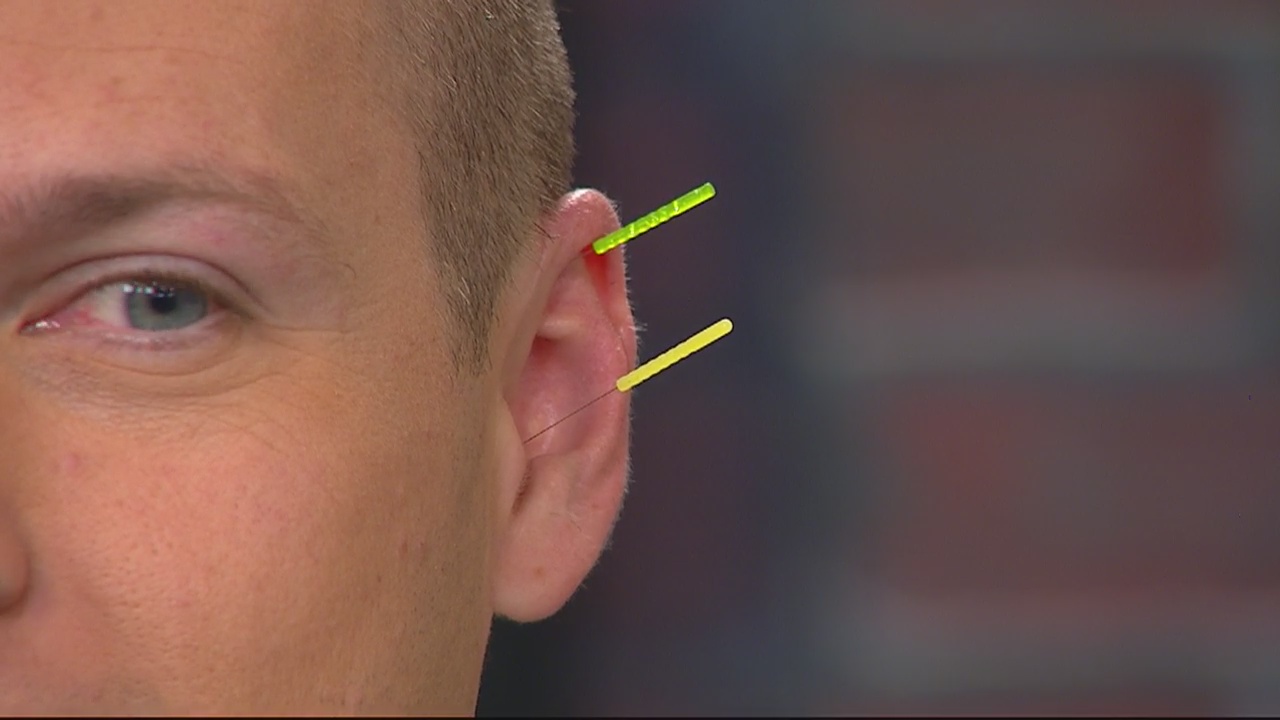 The Doctor Is In: Acupuncture on The Nine