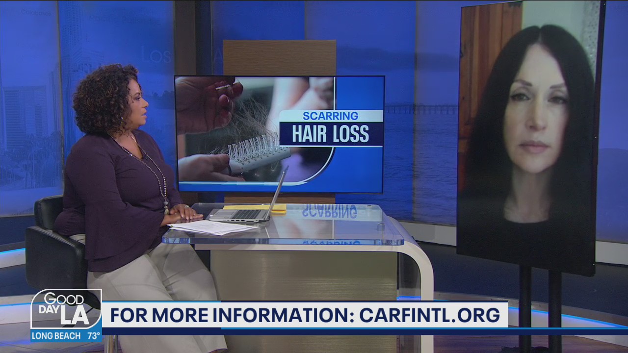 Writer Lindsay Martell shares her hair loss story after losing her eyebrows