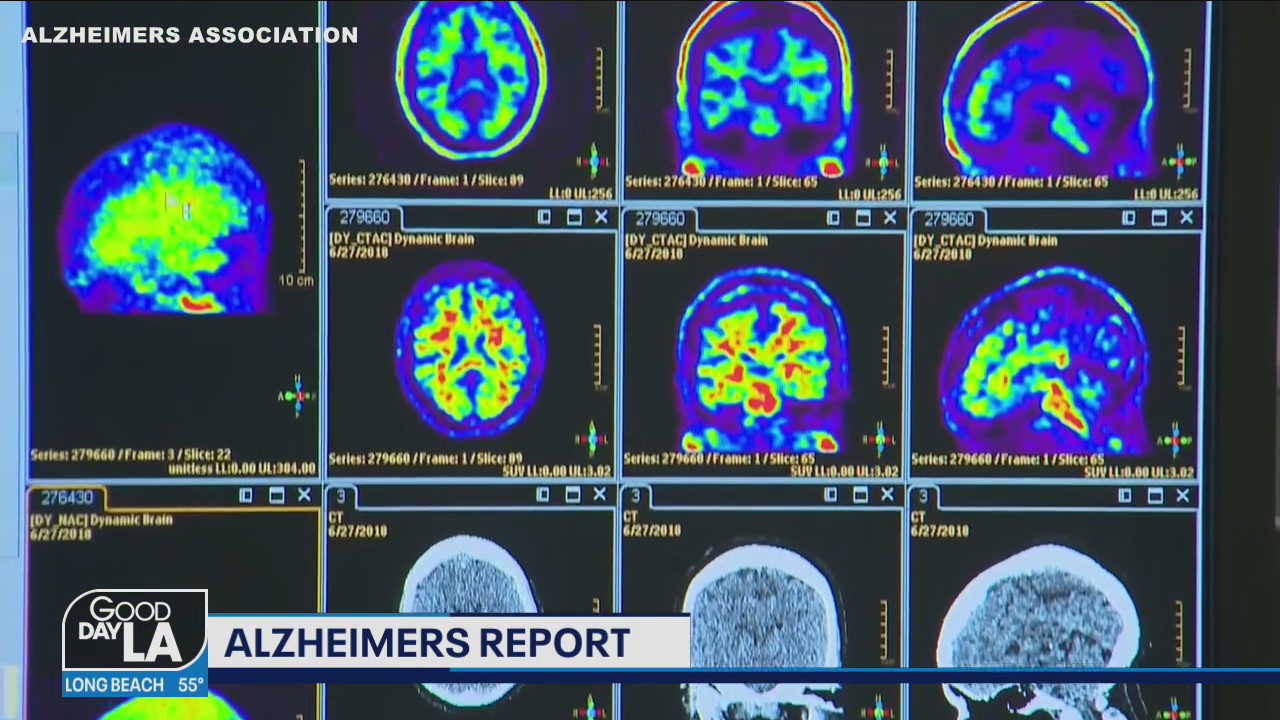 Forgetfulness vs Alzheimer's