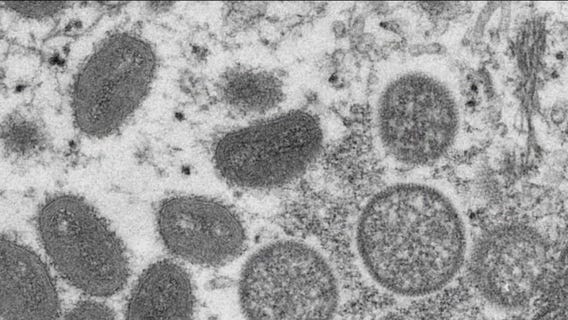 First suspected case of monkeypox reported in LA County
