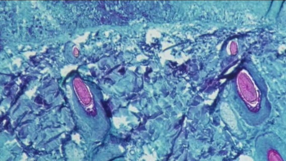 LA County reports 1st presumed case of monkeypox