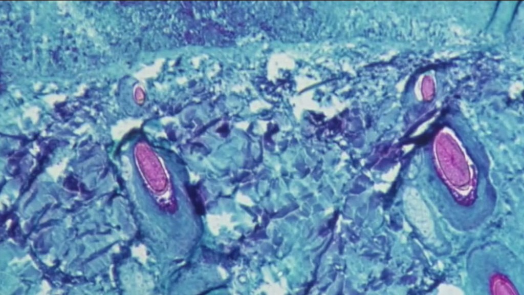 LA County reports 1st presumed case of monkeypox