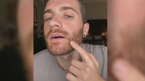 LA man opens up about his monkeypox battle