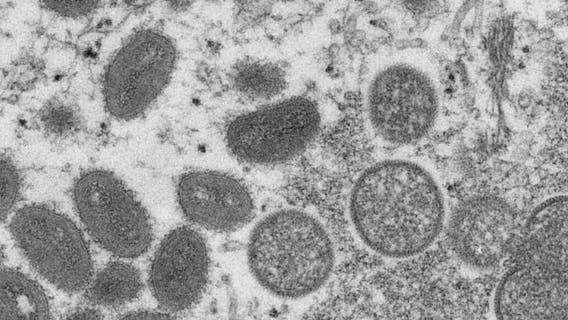 Limited supply of monkeypox vaccine now available