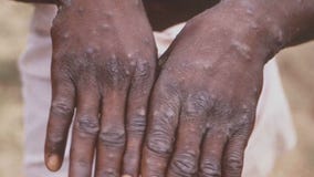 Monkeypox: California under state of emergency