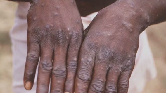 Monkeypox: California under state of emergency