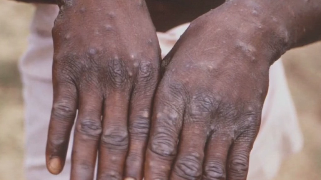 Monkeypox: California under state of emergency