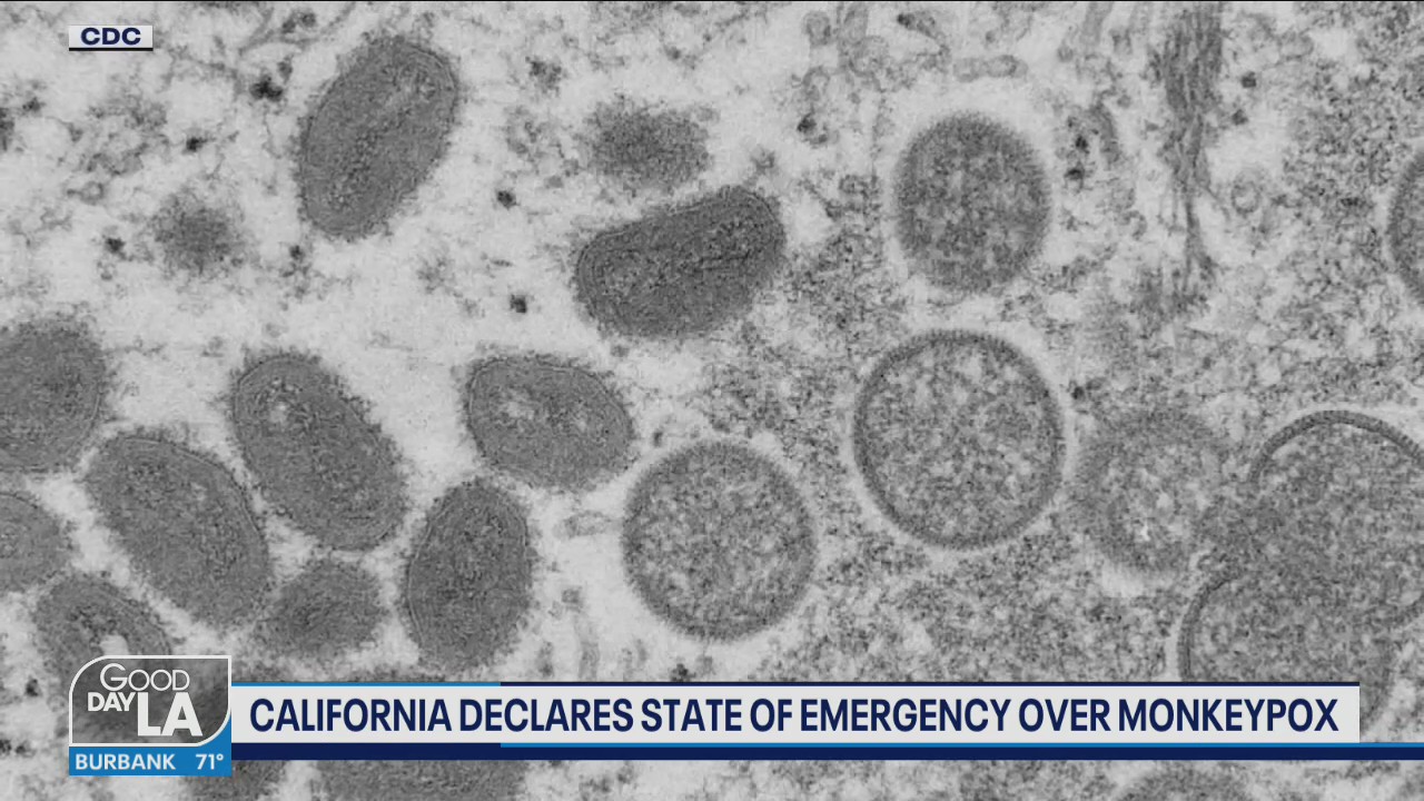 California declares State of Emergency over monkeypox
