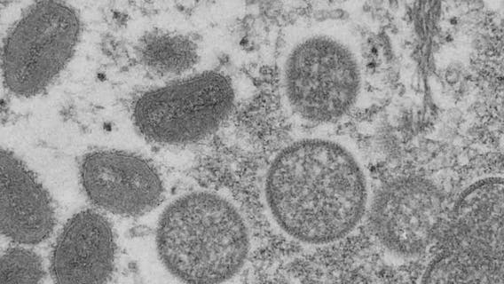 LA County declares local emergency amid rise in monkeypox cases