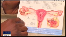 The Doctor Is In: Endometriosis