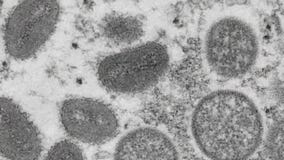 LA County investigating possible monkeypox death