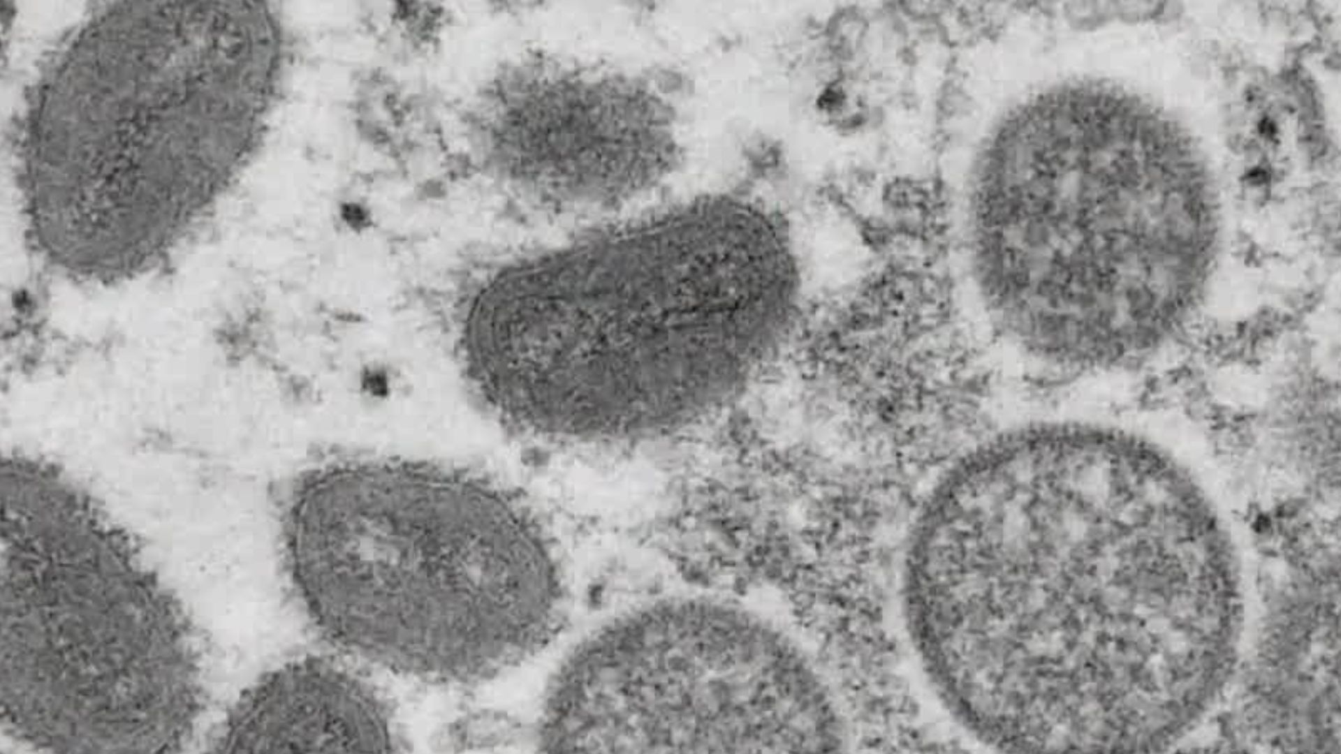 LA County investigating possible monkeypox death