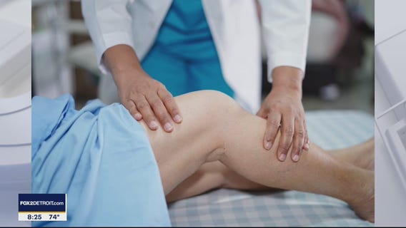 The Doctor Is In: Varicose Veins