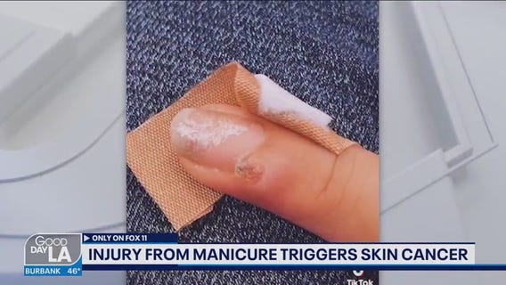 Injury from manicure triggers skin cancer