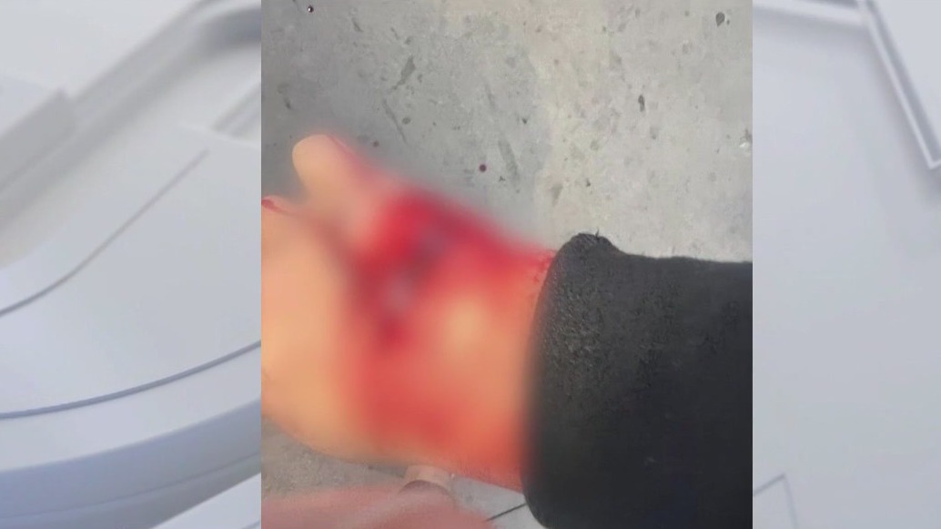 Venice man survives brutal dog attack