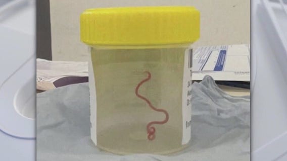 Neurosurgeon plucks worm out of woman?s brain