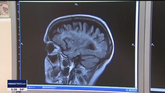 Stroke effects more people under 50: what strokes to look out for