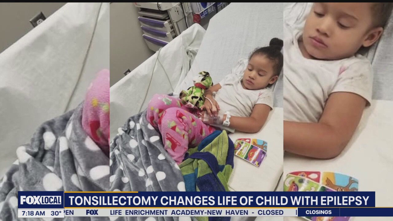 Tonsillectomy changes life of child with epilepsy