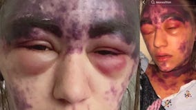 Hospital requires vaccinations, woman has severe reaction