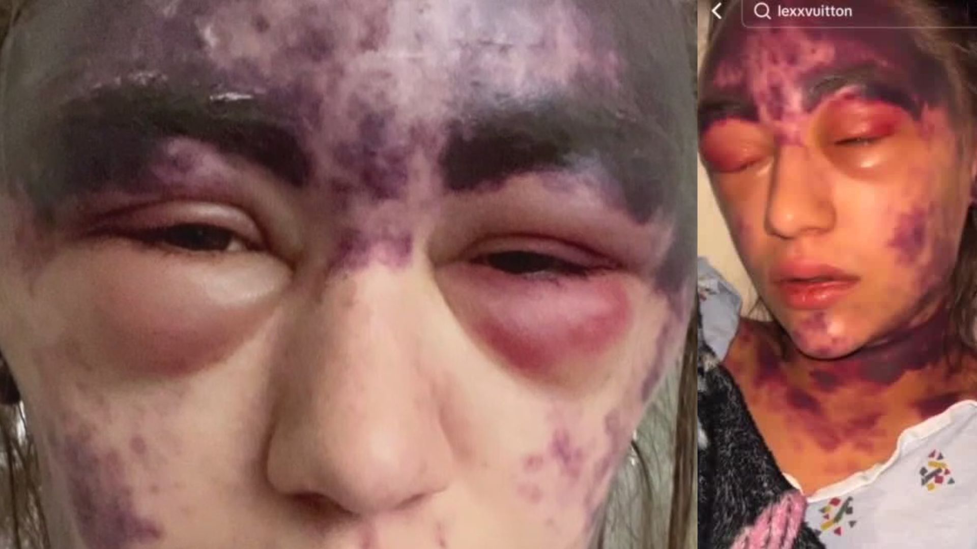 Hospital requires vaccinations, woman has severe reaction