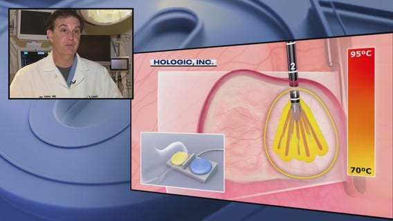 Fibroids are often misdiagnosed - here's what every woman needs to know