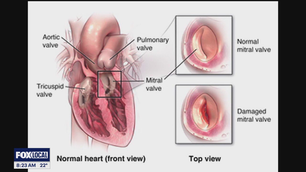 The Doctor Is In: Corewell Health's Mitral Valve program and cardiovascular health and longevity