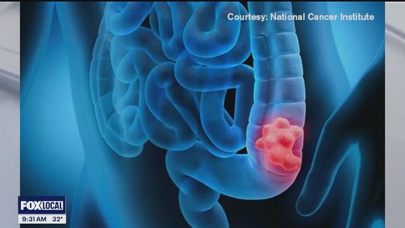 The Doctor Is In: Lower your risk of colon cancer