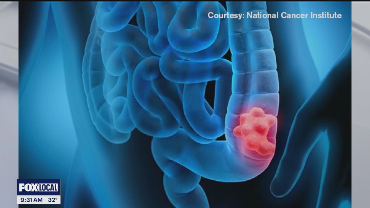 The Doctor Is In: Lower your risk of colon cancer