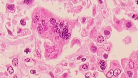 Second confirmed case of measles in Michigan