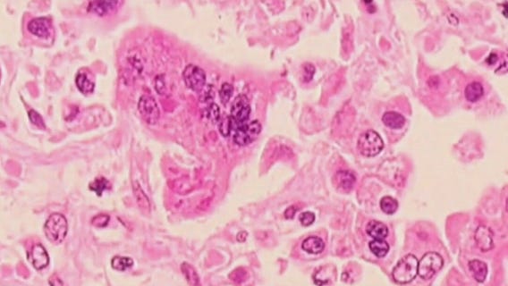 Second confirmed case of measles in Michigan