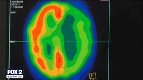 The Doctor Is In: What happens during a stroke and how "BE FAST" can save lives and reduce brain damage