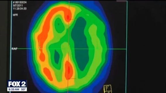 The Doctor Is In: What happens during a stroke and how "BE FAST" can save lives and reduce brain damage