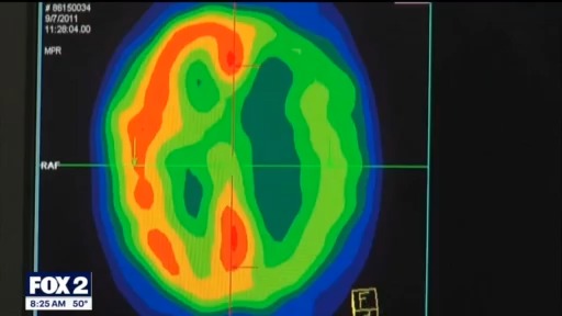 The Doctor Is In: What happens during a stroke and how "BE FAST" can save lives and reduce brain damage