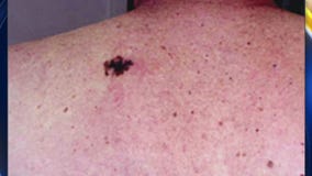 Melanoma in young people