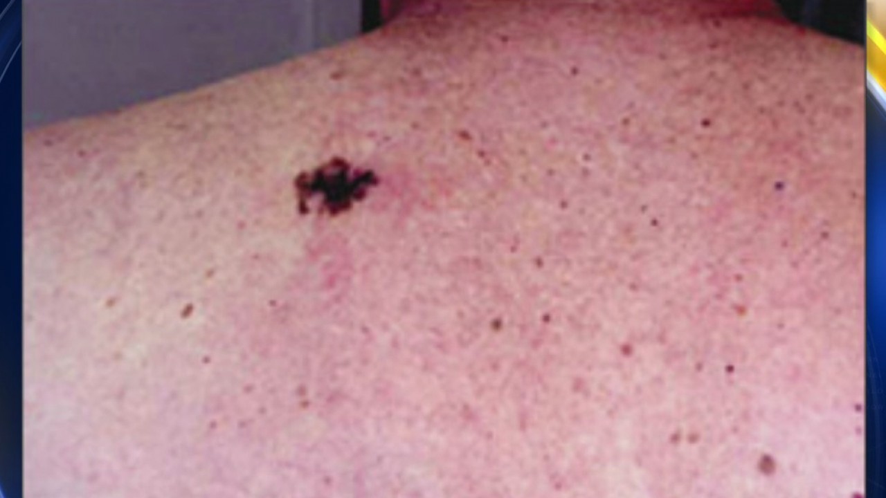 Melanoma in young people