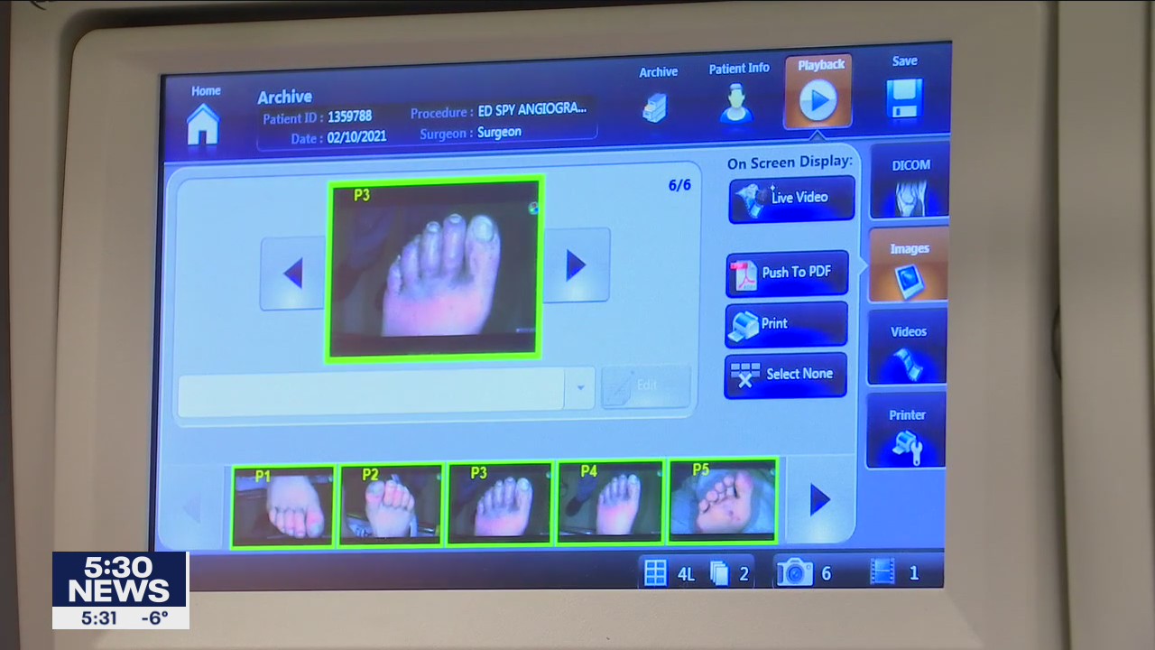 New device allows for faster treatment of frostbite patients