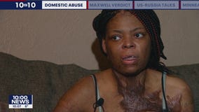 Woman set on fire by ex-boyfriend concerned he?ll get off easy on plea deal