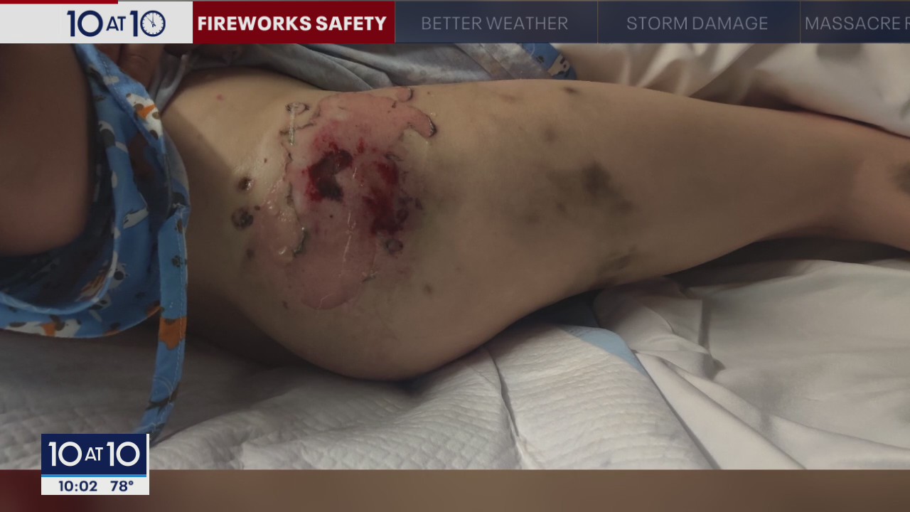 10-year-old St. Paul boy recovering after being hit with defective firework