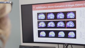 Promising trial for Alzheimer's treatment