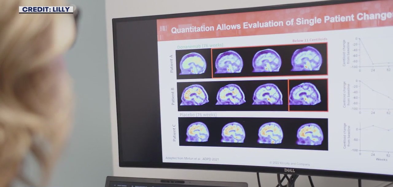 Promising trial for Alzheimer's treatment