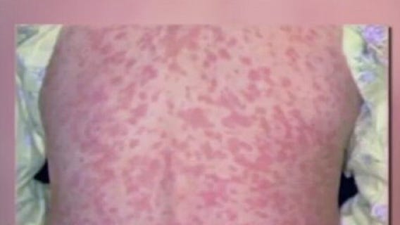 Possible measles case reported in Bell County