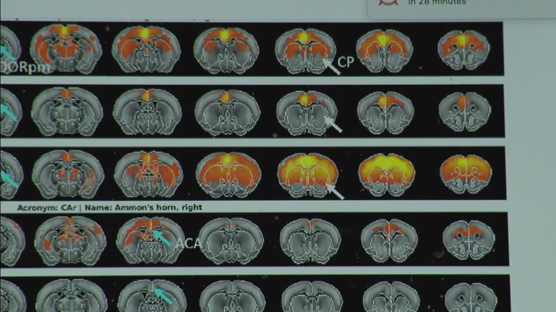 U of M gene therapy for rare child brain disorder