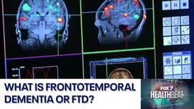 What is frontotemporal dementia?