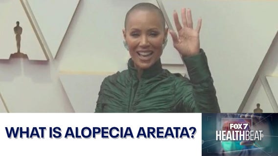 What is alopecia areata?